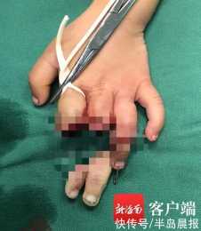 揪心！1歲小孩被倒塌圍牆砸斷2根手指，醫生奮戰6小時