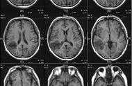 神經系統MRI影像學習：膠質母細胞瘤（顱腦惡性腫瘤）