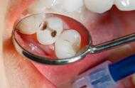 為什麼牙齒本來不痛，補完牙齒後反而開始疼痛了？
